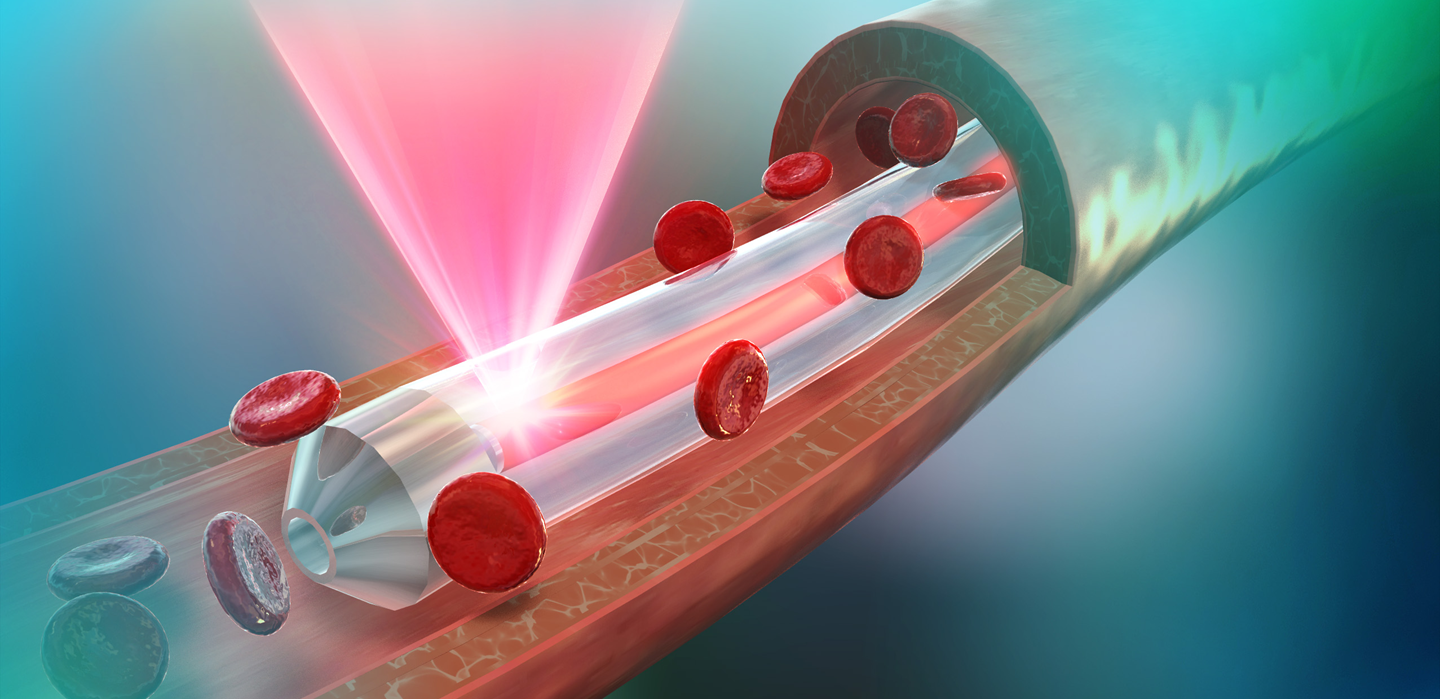 #slidecaption1 世界初の経血管光治療